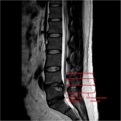 Risk factors for hidden blood loss in unilateral biportal endoscopic lumbar spine surgery